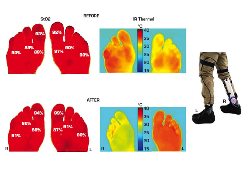 Cooling Insoles Reduce Foot Temperature, Tissue Breakdown Medical